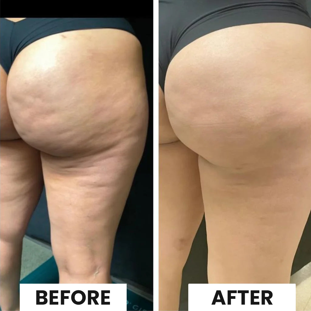 Aurolya™ Cellulite relief in 30 days